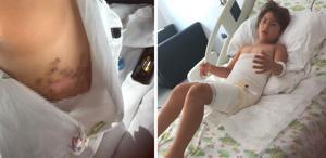 Düğün felaketi oldu: 8 yaşındaki Elif, 7 operasyon geçirdi