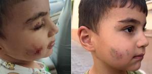 Sincan’da Lağım Faresi Çocuğu Isırdı, Kuduz Aşısı Yapıldı