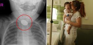 Kardeşi fark etti, hastaneye koştular 15 aylık bebeğin yemek borusundan çıkanlar şoke etti