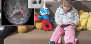 5 yaşındaki Polen yıllarca böyle yaşamış Burnundan ameliyatla çıkardılar