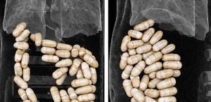 İzmir’de 2 şüphelinin midesinden 1 kilo 304 gram uyuşturucu çıktı