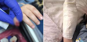 AVM’de yürüyen merdivene eli sıkışan çocuğun parmağı koptu