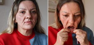 Diş ağrısı şikayetiyle gitti, 25 dişinden oldu