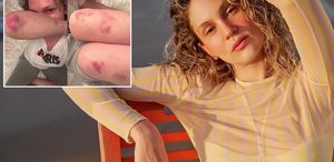 Farah Zeynep Abdullah’ın vücudundaki morluklar korkuttu