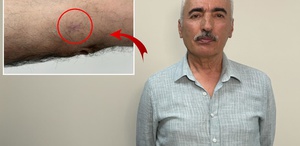 Kolundaki 1 santimetrelik yara kanser çıktı