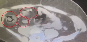 Kars’ta İranlı kuryenin midesinden 571 gram metamfetamin çıktı