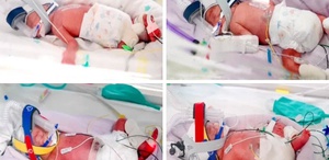 Avustralya’da bir kadın doğal yolla gebelik sonucu tek yumurta dördüzleri dünyaya getirdi