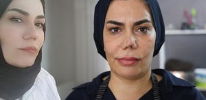 Burun estetiği faciayla sonuçlandı: Kadının hayatı kabusa döndü