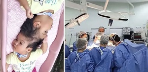 Yapışık ikizlerden acı haber: Kalpleri 14 dakika arayla durdu