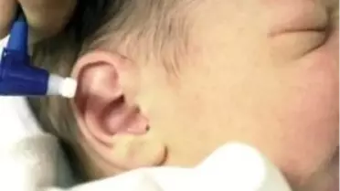 4 Bin Bebek İşitme Engelli Doğuyor