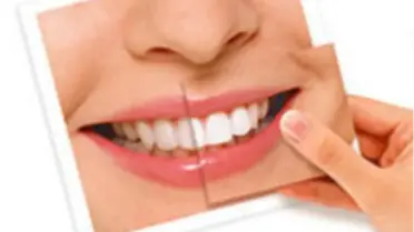 Diş Beyazlatmada Son Trendler