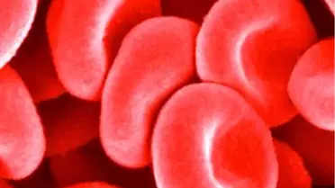 'Pıhtı Atması' Ölümcül Olabilir!