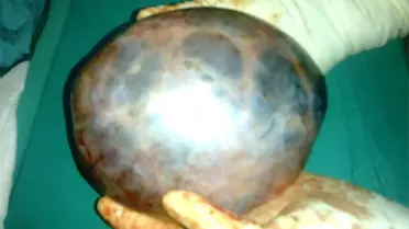 Yumurtalığından 1,5 Kilo Kist Çıktı