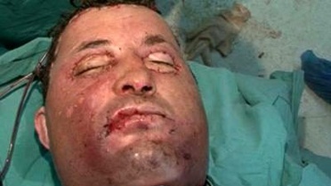 Yüz Naklini Yapan Profesör Özkan Birebir Benzemeyecek