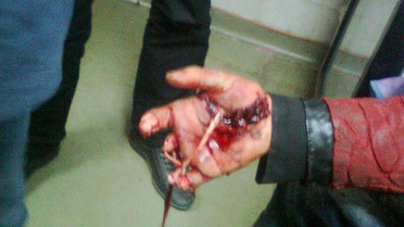 Polise Attığı Bomba Elinde Patlayan Çocuğun Tedavisini Devlet Yaptıracak