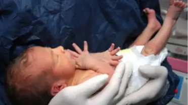 'Sezaryene Karşı Sigaradaki Gibi Mücadele Edelim'