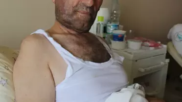 Çene Kemiği Tümörüne Leğen Kemiği Şifa Oldu