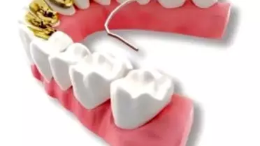 3M Unitek'ten Ödüllü Diş Teli: Incognito™ Lite