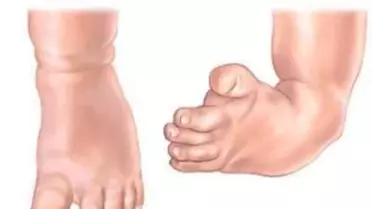 Çarpık Ayak Tedavisine Ameliyatsız Çözüm