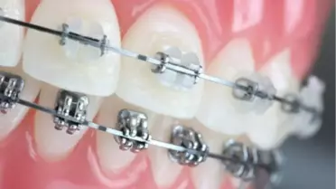 Dişlerinizde Çapraşıklık mı Var?