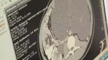 7 Kiloluk Böbrek Ameliyatla Alındı