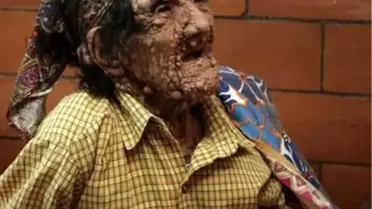 Cüzzamdan Korkmayın, Cüzzamı Tanıyın