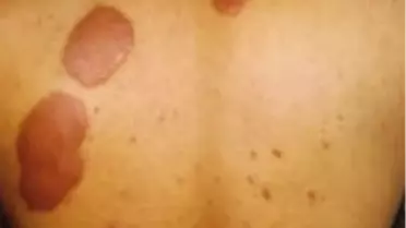 Didim Toplum Sağlığı Merkezi'nden Cüzzam Bilgilendirmesi