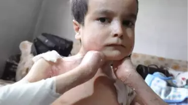 İki Kardeş Mum Gibi Eriyor