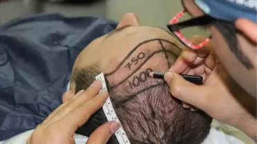 Saç Ekiminde Başarı Giderek Yükseliyor