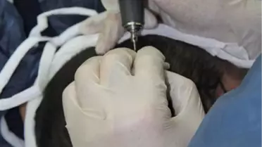 Saç Ekiminde Başarı Yükseliyor