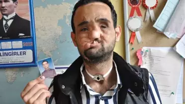 Oğlu Yüz Nakli Olacak Babanın Dramı