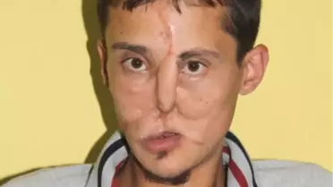 Kırklareli gencin yüz nakli umudu
