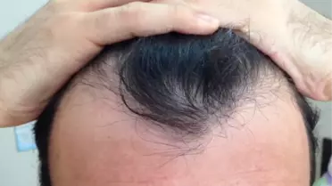 Saç Dökülmesinin Psikolojik Sonuçları