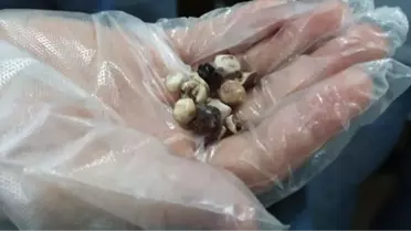 Safra Kesesinden 100 Taş Çıktı