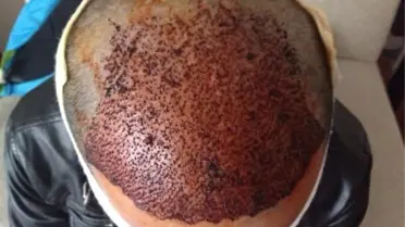 Yabancılar Saç Ekimi İçin Türkiye'yi Tercih Ediyor