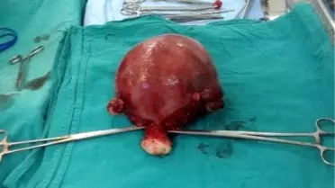 Karnından 4 Kilo Ur Çıktı