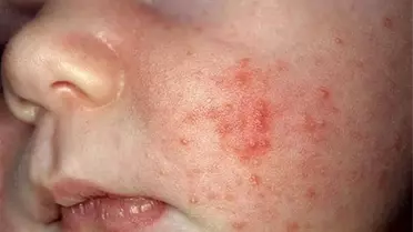 Burun Tıkanıklığı, Çocuklarda Kurdeşen Sebebi'