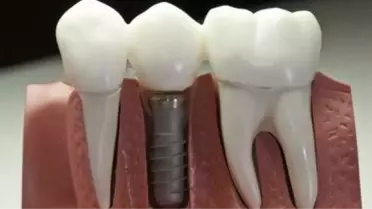 Reklamlardaki Yanlış Algı Çocuklarda Diş Çürümesi Nedeni