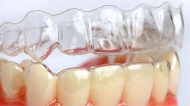 Tele Gerek Kalmadan Çarpık Dişler Tarih Olacak