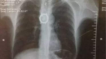 Röntgende, Midesinde Kol Saati Çıktı