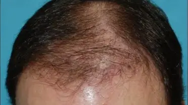 Yazın Saç Ekimi Olur Mu?