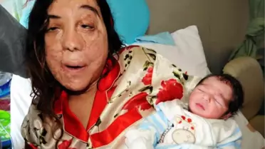 Yüz Nakli Bekleyen Dilek'in Bebek Sevinci