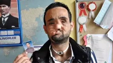 Yüz Nakli Yapılan Sert, Evleniyor