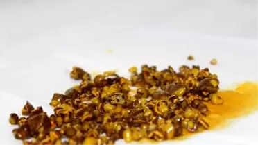 Şanlıurfa'da Safra Kesesinden Çıkan Taş Doktorları da Şaşırttı