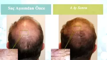 Saç Dökülmesine FDA Onaylı Çözüm Türkiye'de