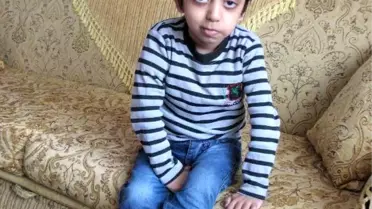 6 Yaşındaki Abdullah'ın Beyin Tümörüyle Savaşı