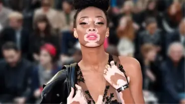 Hastalığını Avantaja Çevirdi: Winnie Harlow