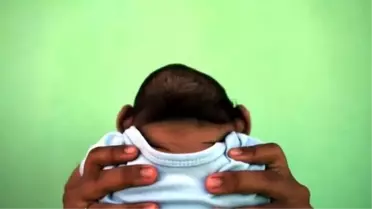 İspanya'da İlk Mikrosefali Bebek Doğdu