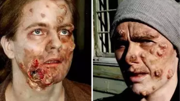 Cüzzam korkulacak bir hastalık olmaktan çıktı ama…