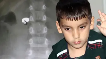 7 Yaşındaki Çocuğun Yuttuğu Pil, Bağırsağına Kadar İndi